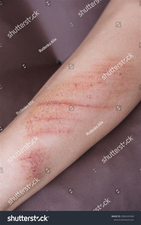 7,790 Skin abrasion Images, Stock Photos & Vectors | Shutterstock