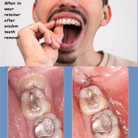 After Wisdom Teeth Removal Wisdom Teeth: Removal | Spectrum Health