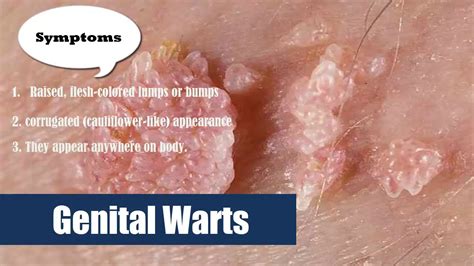 16# Genital Warts HPV Human Papilloma Virus in Women and men symptoms ...