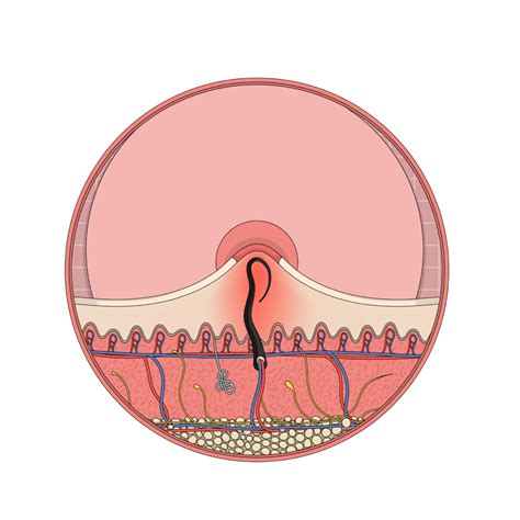 What Does An Infected Ingrown Hair Look Like? | Ingrown Hair Cyst ...