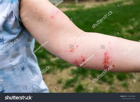 Severe Poison Ivypoison Oak Rash Reaction Foto Stok 1758184889