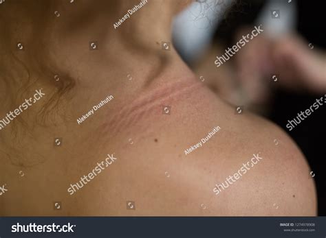 Rope Mark On Womans Neck Stock Photo 1274978908 | Shutterstock
