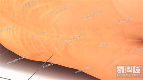 combined spinal  epidural anaesthesia cse   regional