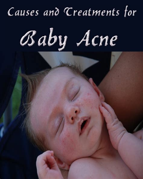 Causes and Treatments for Baby Acne