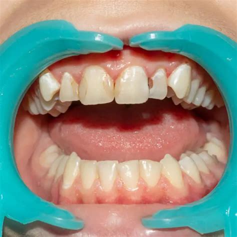What is dental fluorosis? - Euro Dental Center