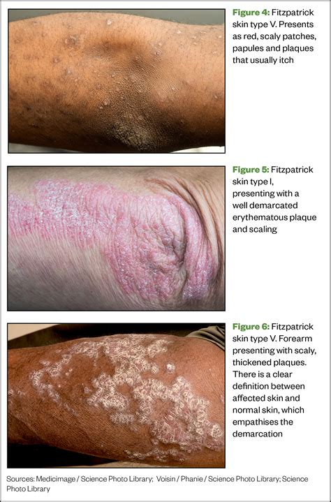 Recognising common skin conditions in people of colour - The