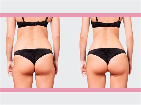 Lipo No Culote Antes E Depois - Lipo antes e depois: os resultados da lipo na barriga, costas, flancos ...