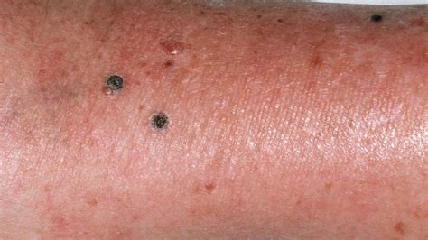 Nodular Melanoma Pictures: Symptoms, Treatment, and More