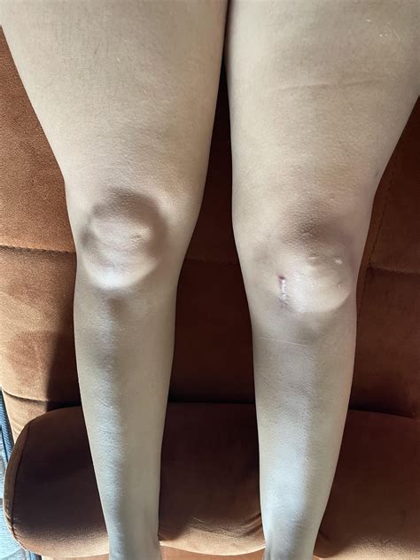 Knee won’t lock after 5 months post-op from tearing my ACL completely