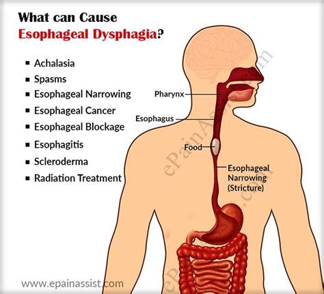 esophageal-dysphagia-general-information-top-nyc-experts-02 - Best ...