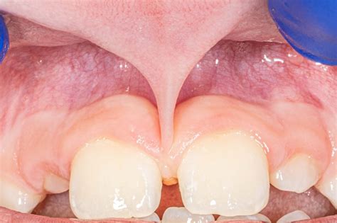 frenectomy michigan implants  periodontics