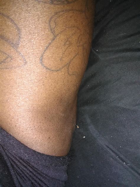 Why does my leg look like this? : medical_advice