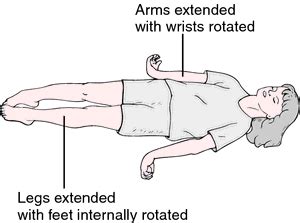 Decerebrate Posture - Mobile Physiotherapy Clinic Ahmedabad Gujarat