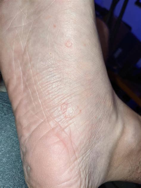 Ringworm on bottom of foot? : r/ringworm