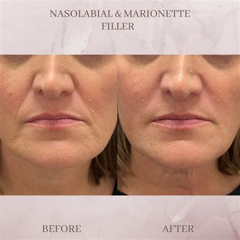 nasolabial fold marionette filler eluma laser aesthetics