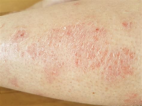 What is psoriasis and how can it be treated