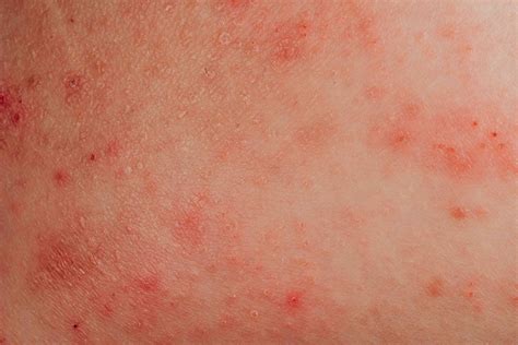 how to get rid of underarm rash