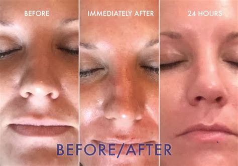 Microneedling before and after – JJ ELLIE SKINCARE