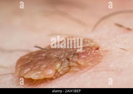 Macro photo of a skin wart, papilloma virus infection Stock Photo - Alamy