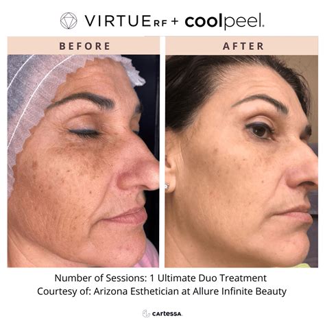 coolpeel laser skin resurfacing  laser  aesthetics wellness