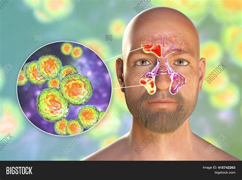 Moraxella Catarrhalis Image & Photo (Free Trial) | Bigstock