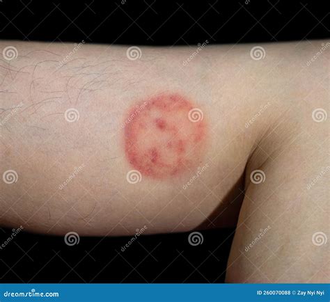 fungal infection called tinea corporis stock photo image  dark