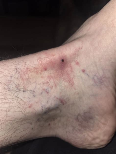 Brown Recluse Spider Bite Stage 1