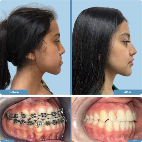 orthognathic jaw surgery     eldon berthold blog