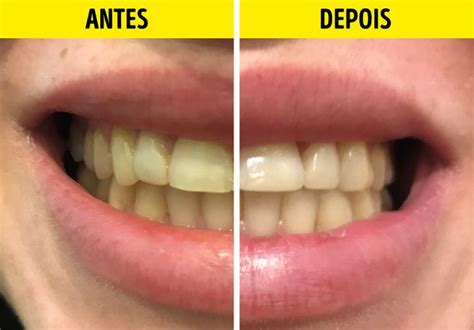 Bicarbonato De Sodio Dentes - Experimentamos 5 formas caseiras de clarear os dentes (o bicarbonato de ...