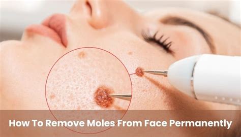 A Detailed Guide to Remove Moles on the Face Permanently