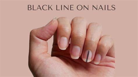 Spotting a Black Line on Nails and What it Signifies - VIMS