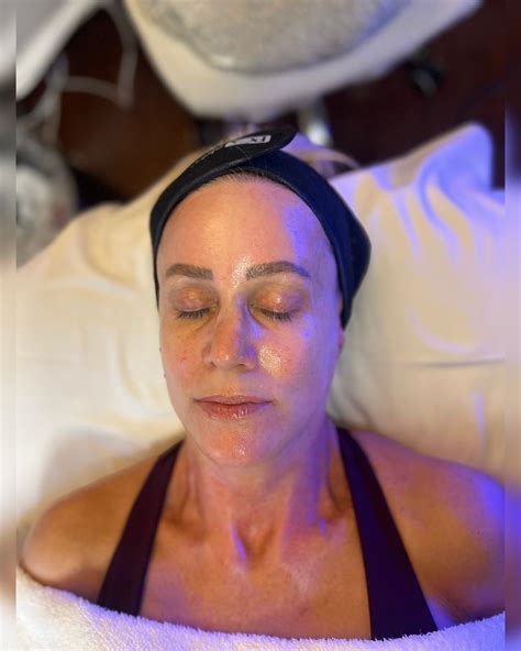 What to Expect During Your First Chemical Peel in Costa Mesa