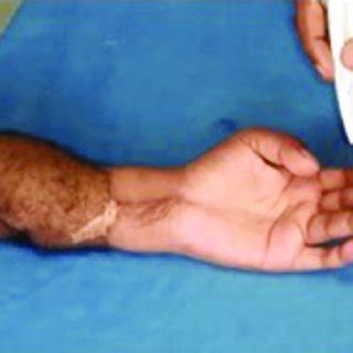 Monofilament testing | Download Scientific Diagram