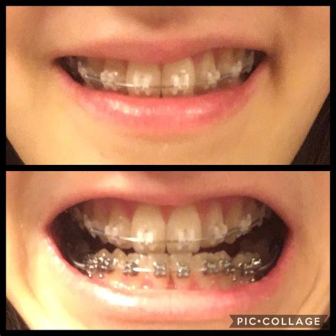 The real reason I have braces 😎 : braces