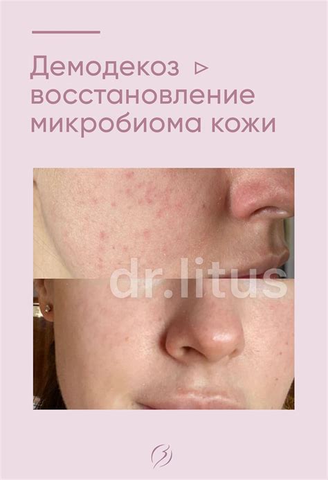 Демодекоз, розацеа восстанавливаем микробиом кожи | Розацеа, Кожа, Врачи