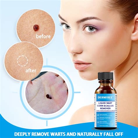 Removes Skin Tags,Fast-Acting Wart Remover Plantar Wart, Genital Wart