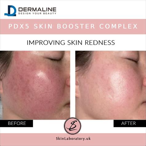 skin booster unlock youthful radiant skin