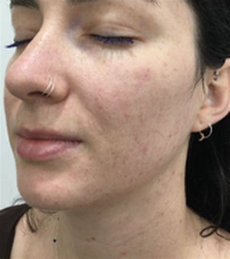 BBL Treatments | Laser Clinics Australia