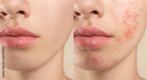 Collage with photos of teenage girl with acne problem before and after treatment, closeup ...