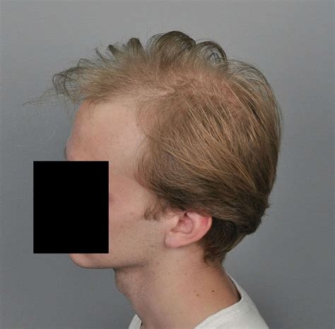 hair transplant recovery timeline 2