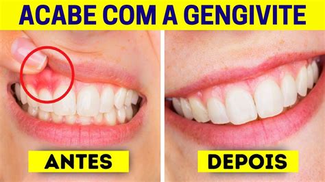 Como Acabar Com A Gengivite Rapido - Acabe Com a GENGIVITE Com 4 Excelentes Remédios CASEIROS ! - YouTube
