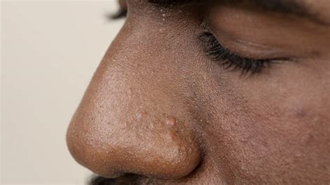 Unbelievable Blackhead Removal 2024: Avoid These Common Mistakes - qtit27c