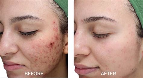 chemical peel    training insights