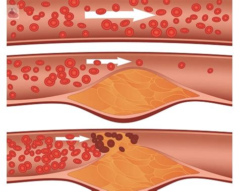 Hiperlipidemia O Que É - ¿Cómo se relaciona la Hiperlipidemia con otras enfermedades? | Top Doctors