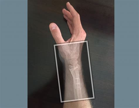 distal radius fracture splint type nerymotorcycle