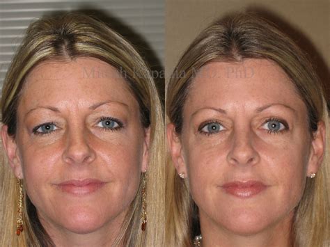 Before and three months after upper blepharoplasty surgery | Boston