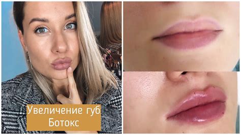 Ботокс Губ Цена Фото — Фото Картинки