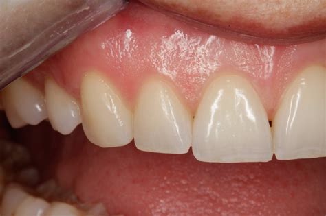 healthy gums color