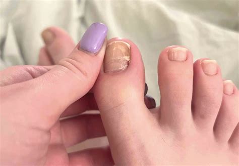 purple  toenail big toe toenail falling