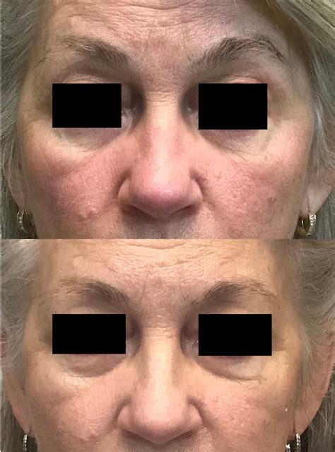 Blue Light Treatment For Rosacea | Shelly Lighting